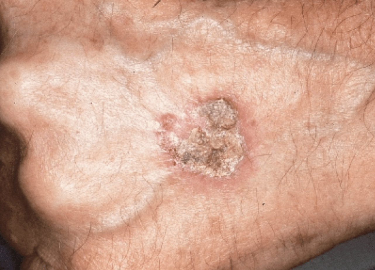 tumore della pelle
