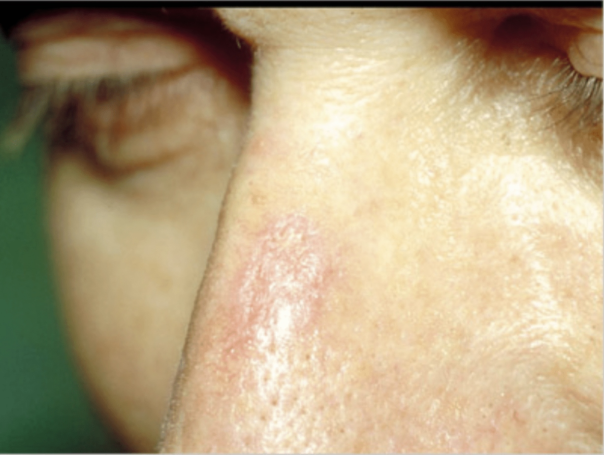 tumore della pelle